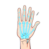 Replantation of amputated finger